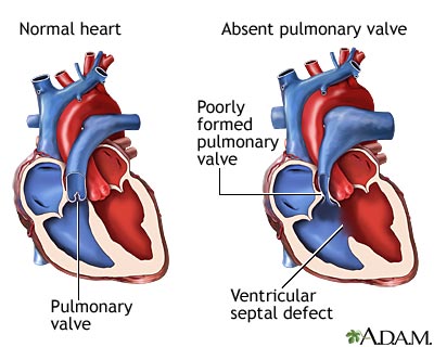 VALVOPLASTIA PULMONAR POR CATTER BALO