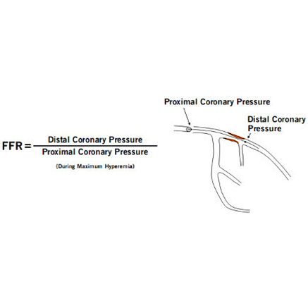 Fluxo Fracionado de Reserva Miocrdica (FFR)