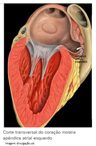 OCLUSO DE APNDICE ATRIAL ESQUERDO