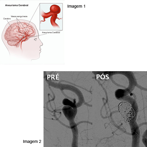 Embolizao de Aneurisma Cerebral