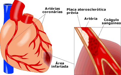 INFARTO DO MIOCARDIO