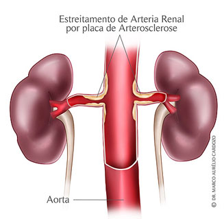 TRATAMENTO PERCUTNEO DA ESTENOSE DA ARTRIA RENAL (E. A. R.)