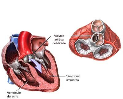 ESTENOSE ARTICA 