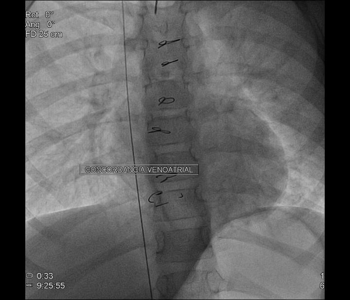 Avaliao tardia da cirurgia de Jatene