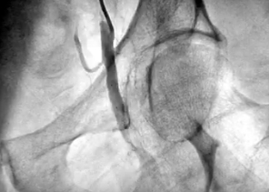 ANGIOPLASTIAS DE MEMBROS INFERIORES