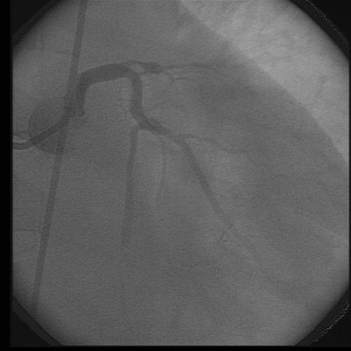 INFARTO AGUDO DO MIOCRDIO COM SUPRA DE ST