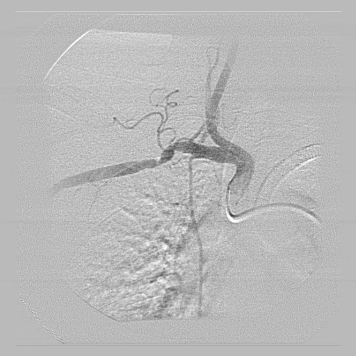 ANGIOPLASTIA DE ARTRIA SUBCLVIA COM STENT CONVENCIONAL.