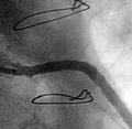 ANGIOPLASTIA DE PONTE DE SAFENA