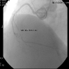 DISSECO OSTIAL DE CORONÁRIA DIREITA DURANTE CORONAROGRAFIA DIAGNSTICA SEGUIDA DE ANGIOPLASTIA