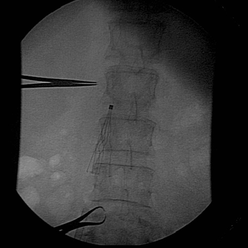 EMBOLIA PULMONAR BILATERAL 