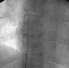 RETIRADA  DE CORPO ESTRANHO INTRAVASCULAR