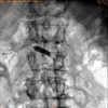 ANGIOPLASTIA RENAL BILATERAL