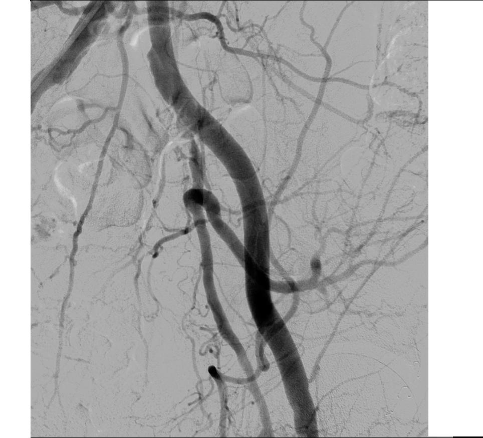 Angioplastia com Bales Farmacolgicos em Artria Tibial