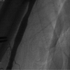 ANGIOPLASTIA DE ARTRIA BRAQUIAL POR VIA RADIAL