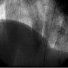 COMUNICAO INTERVENTRICULAR