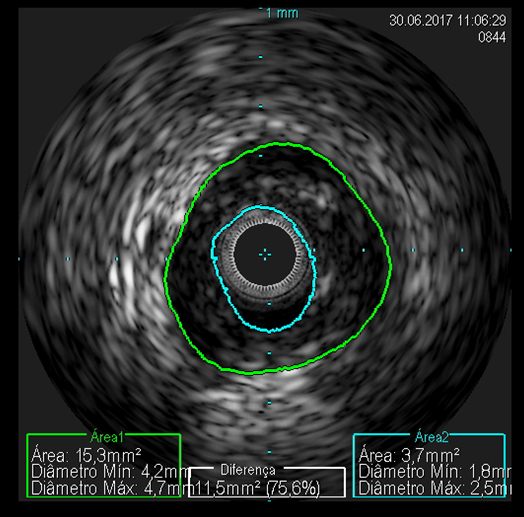 Implante de stent coronrio farmacolgico (DES) guiado por ultrassom intracoronariano (IVUS)