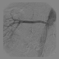 ANGIOPLASTIARENAL  DIREITA COM STENT