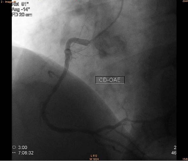 PERFURAO CORONRIA DURANTE ANGIOPLASTIA NO INFARTO AGUDO DO MIOCÁRDIO