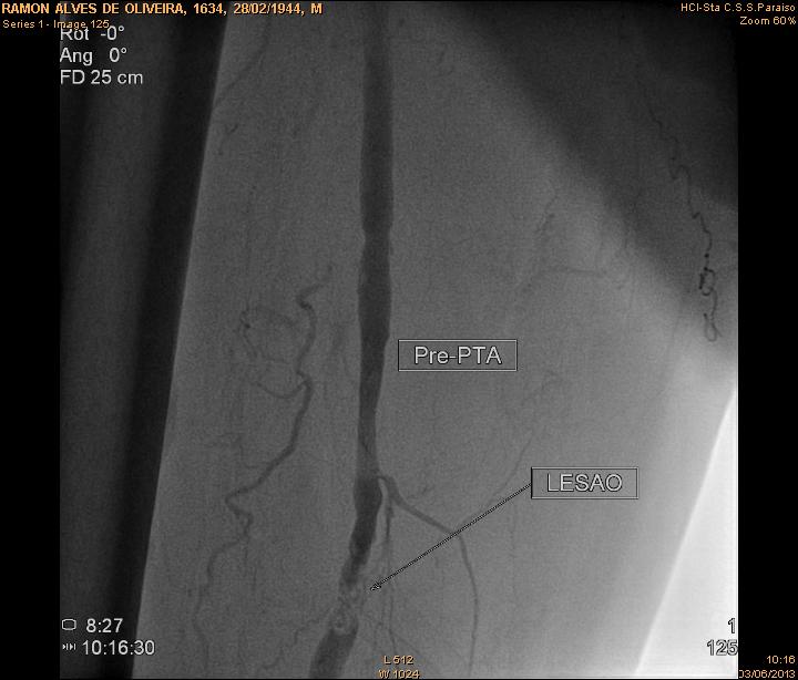 RECANALIZAO SUBINTIMAL DE OBSTRUO DE ARTRIA FEMORAL SUPERFICIAL