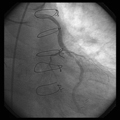 PROCEDIMENTO COMBINADO DE ANGIOPLASTIA DE PONTE DE SAFENA E VALVOPLASTIA ARTICA.