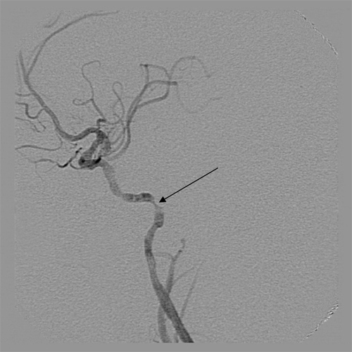 ANGIOPLASTIA CAROTÍDEA POR GRAVE PLACA OBSTRUTIVA 