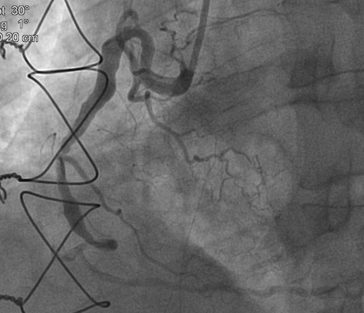 Sndrome Coronariana Aguda no Ps-Operatrio Imediato de Cirurgia de Revascularizao do Miocrdio 