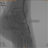 DOENA ARTERIAL OBSTRUTIVA PERIFRICA