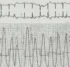 CARDIOMIOPATIA HIPERTRFICA DIMICA OBSTRUTIVA