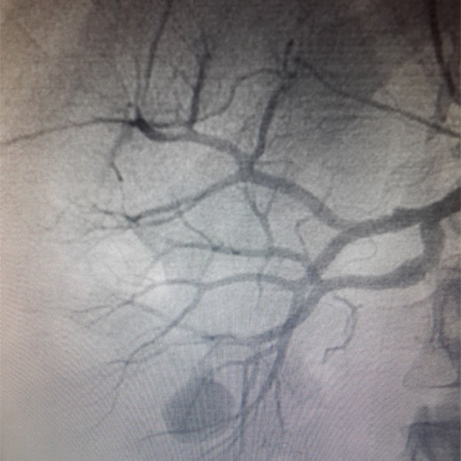 PSEUDOANEURISMA EM ARTRIA RENAL PS LITOTRIPSIA PERCUTNEA